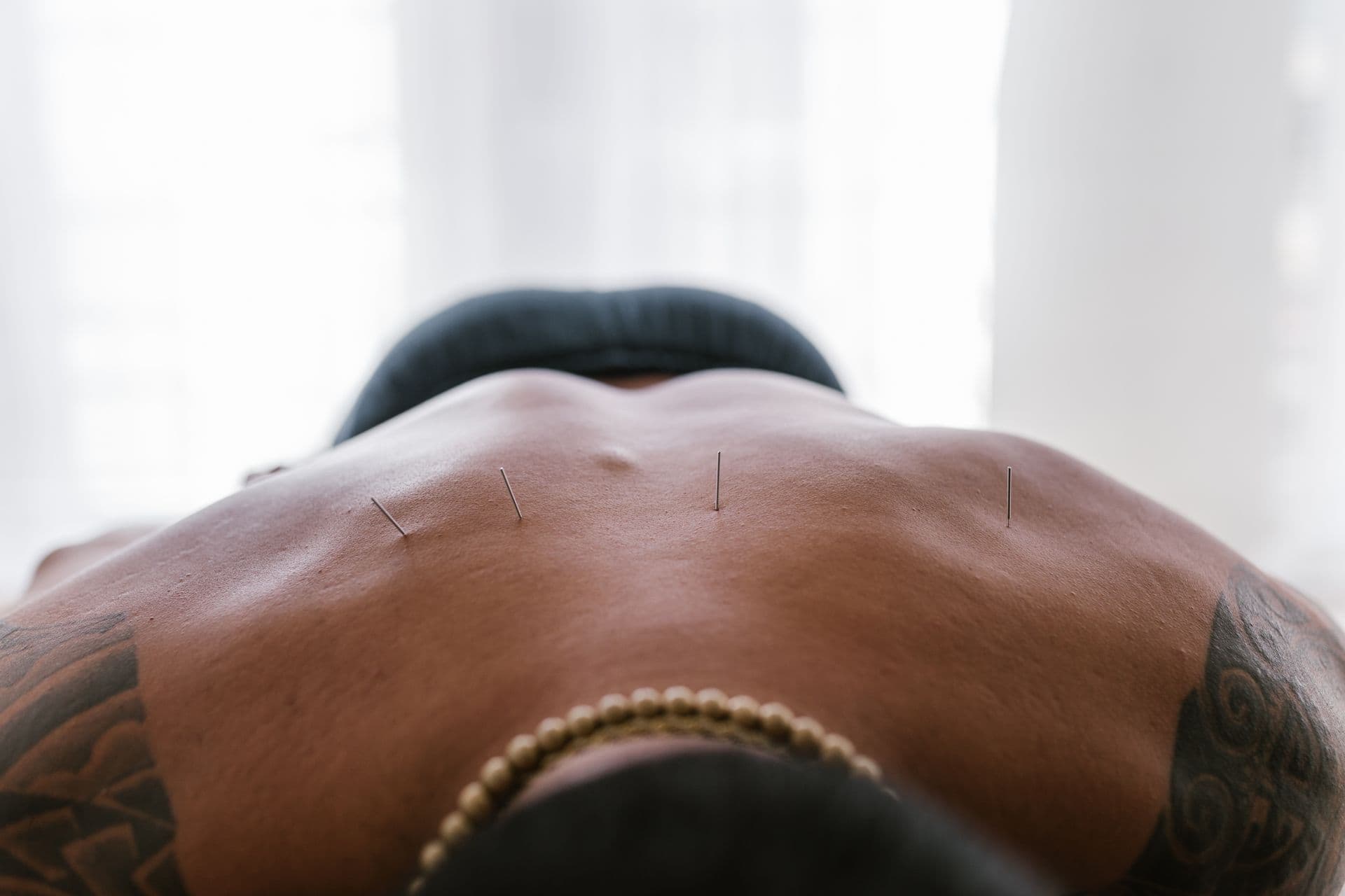 Dry needling needles placed along a patient's upper back during treatment.
